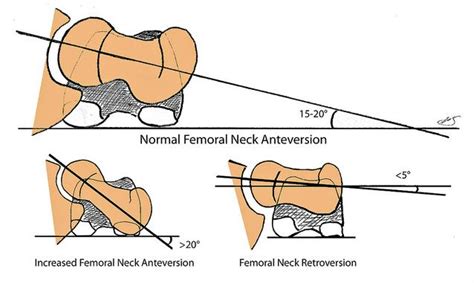 femoral anteversion normal range